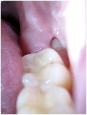 Molar / Wisdom Teeth