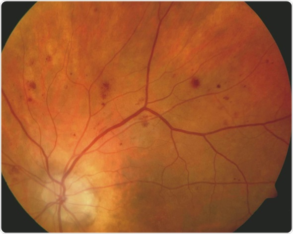 Diabetic retinopathy