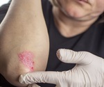 Psoriasis caused by changes in the fat metabolism of skin cells