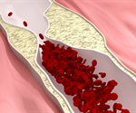 Preventing and Managing Atherosclerosis