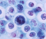 Study offers a potential new strategy to improve treatment responses in multiple myeloma patients