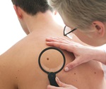 Study reveals how melanoma evolves to resist immunotherapy