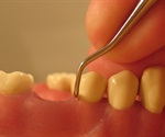 New data supports link between gum disease and heart disease