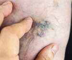 Minimally invasive procedure to treat varicose veins results in less swelling, bruising and minimal pain