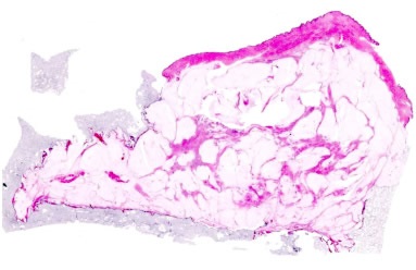 Image of whole-mount breast cancer specimen