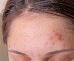 Acne Research