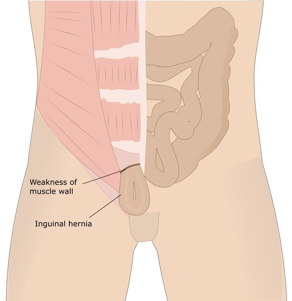 inguinal hernia - Image Copyright: ellepigrafica / Shutterstock