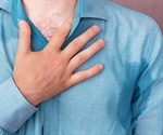 Hyperhidrosis Prognosis and Epidemiology
