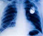 Pacemaker-type device and medicines reduce hospital stays and death rates