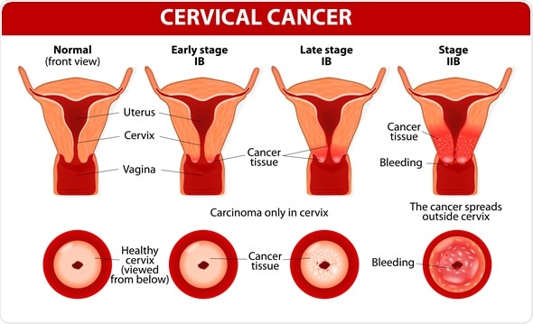Cervical Cancer. Carcinoma of Cervix. Malignant neoplasm arising from cells in the cervix uteri. Image Copyright: Designua / Shutterstock