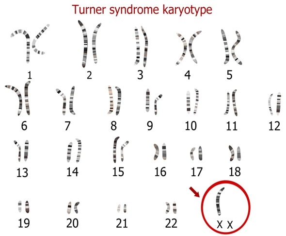 Turner syndrome karyotype - Image Copyright: Zuzanae / Shutterstock