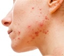 Study reveals widespread unrecognized acne among 35-year-old Finnish women