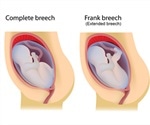 Extended Breech, Flexed Breech and Footling Breech