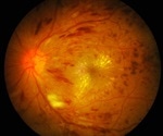 GLP-1 drugs found to protect against diabetic retinopathy