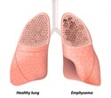 Emphysema detected on CT predicts mortality from all causes