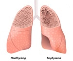 Researchers use mouse models to explain the developmental process behind COPD