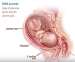 Placenta Accreta