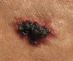 Malignant Melanoma