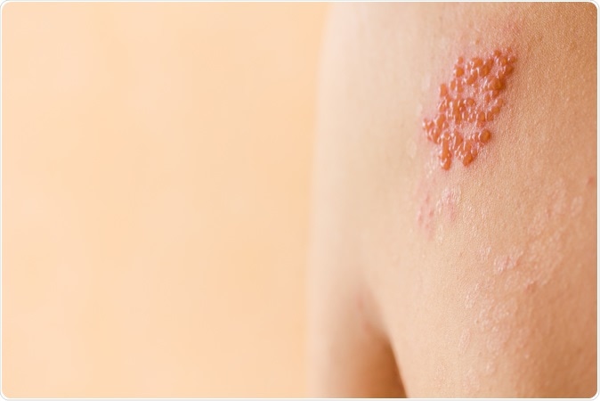 Shingles / herpes zoster. Image Credit: SneSivan / Shutterstock