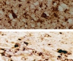 Scientists detect pathological prion protein in skin of CJD patients