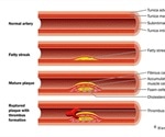 Coronary Artery Disease Prevention