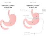Weight Loss After Bariatric Surgery