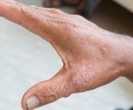 Researchers discover why scleroderma affects women more than men