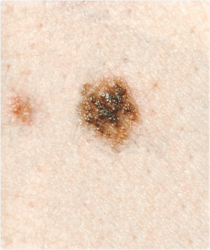 Dysplastic Nevi - This lesion has a dark brown,
