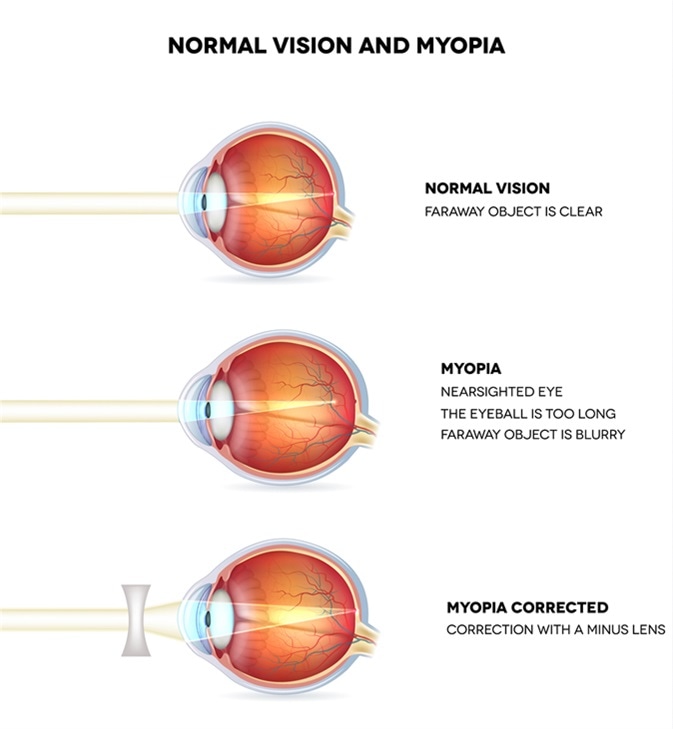 Myopia and normal vision. Myopia is being shortsighted. Myopia corrected with minus lens. Anatomy of the eye, cross section. Image Credit: Tefi / Shutterstock