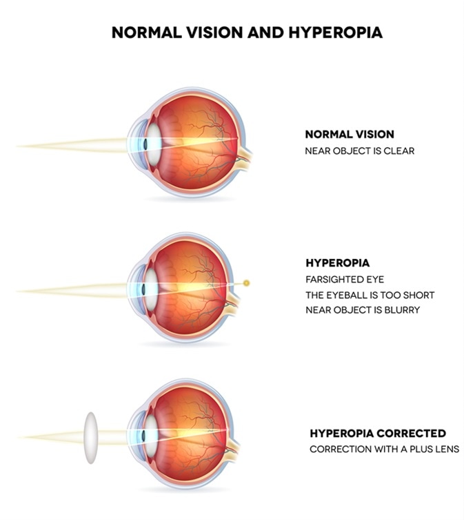 Hyperopia and normal vision. Hyperopia is being farsighted. Illustration shows hyperopia corrected with a plus lens. Anatomy of the eye, cross section. Detailed illustration. Image Credit: tefi / Shutterstock