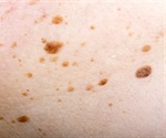 Epidermal Nevus Overview