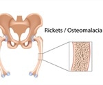 Epidermal Nevus with Bone Cysts and Hypophosphatemic Rickets