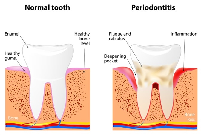 Periodontitis is a inflammatory diseases affecting the periodontium, the tissues that surround and support the teeth. Image Credit: Designua / Shutterstock