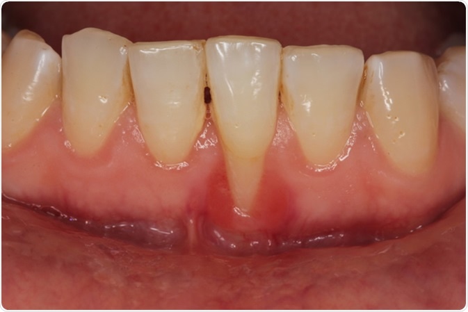 Gingival recession due to dental calculus. Image Credit: dr.kenan / Shutterstock