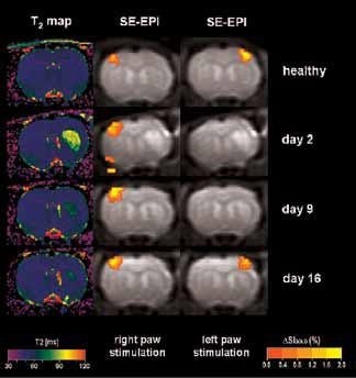 BOLD activation at 7.0 Tesla on animals after stroke, with a resolution of 400 x 400 x 2000 μm3. T2-maps (left column) indicate the lesion on the right hemisphere. BOLD activation on the left healthy hemisphere (center column) and of the ischemic right hemisphere (right column) indicates transient loss of activation during the first two weeks following stroke, followed by full recovery at day 16.