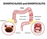 What is Diverticulitis?