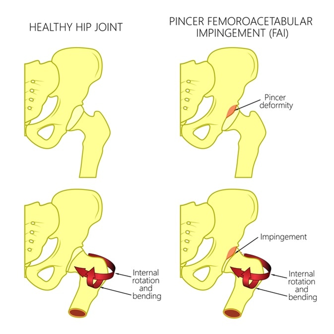 Illustration of a healthy human hip joint and a hip with pincer femoroacetabular impingement. Front view of hip joint. Image Credit: Aksanaku / Shutterstock
