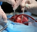 Researchers successfully perform coronary artery bypass without cutting the chest wall