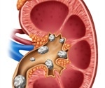 Kidney Stone Diagnosis