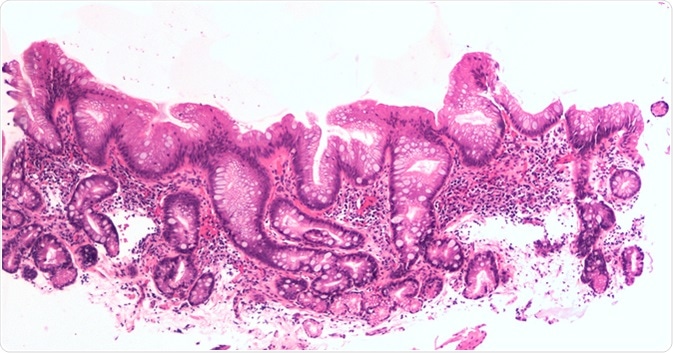 Intestinal metaplasia of the esophagus, aka Barrett