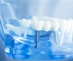 Medical Uses of Dental Implants