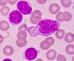 Chronic Lymphocytic Leukemia (CLL) Prognosis
