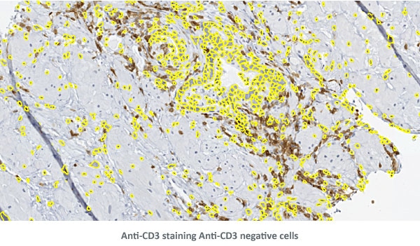 AntiCD3 Det CD3Negs
