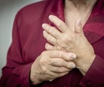 Rheumatoid arthritis found to worsen during and after menopause, study says