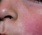 Fifth Disease Causes