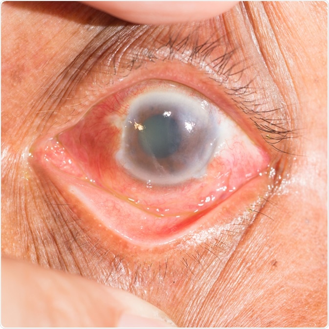 Close up of the acute angel closure glaucoma during eye examination. Image Credit: ARZTSAMUI / Shutterstock