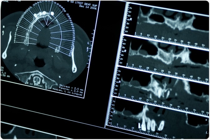 CT Dental Tomography. Image Credit: Flavio Massari / Shutterstock
