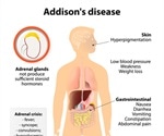 What is Addison's Disease?