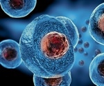 Stem cells transplanted for treatment of Parkinson’s disease