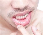 What is the difference between Angular Cheilitis and Herpes Simplex type 1?